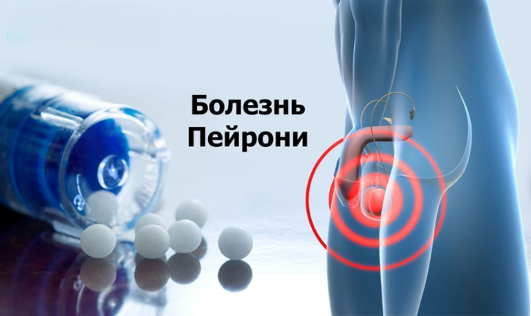 пейрони