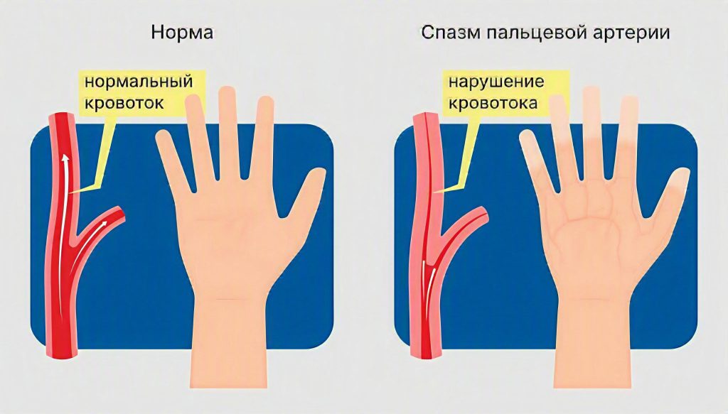 Причины Синдрома Рейно